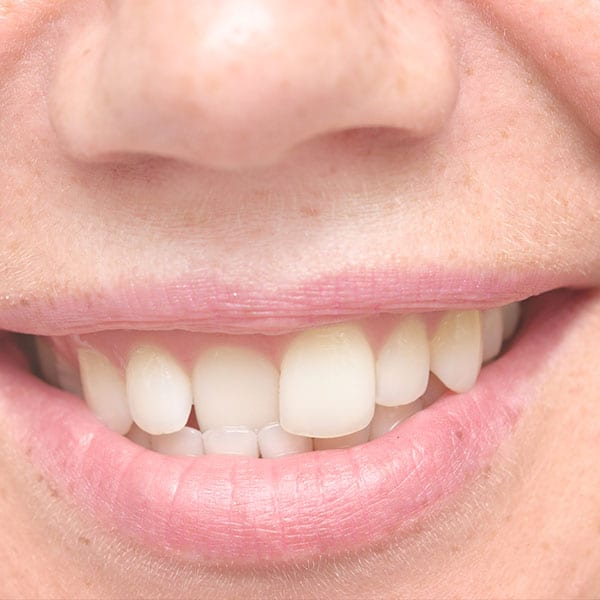 Crooked Teeth Treatment Hampton