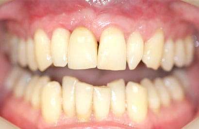 Dental Implant 2 after