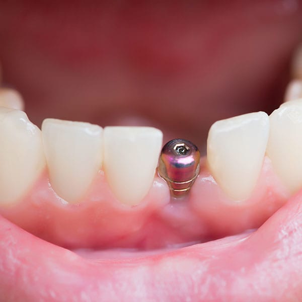 Dental Implant Hampton