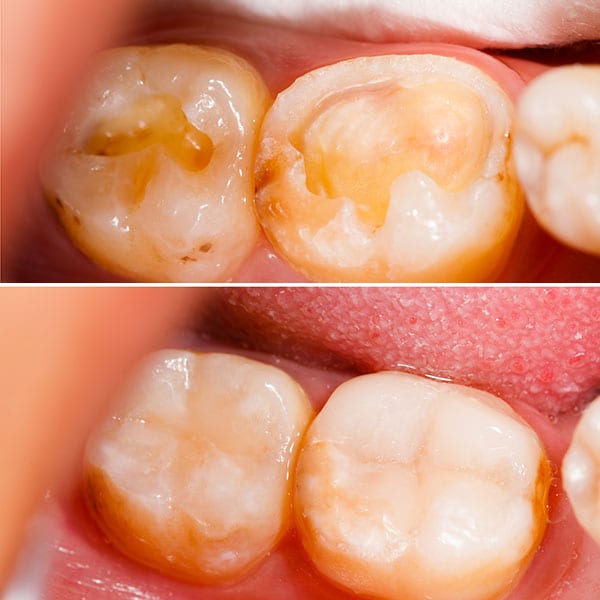 teeth fillings hampton