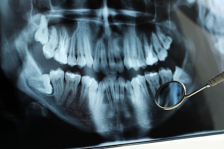 Wisdom Teeth, Why Do They Cause Trouble?